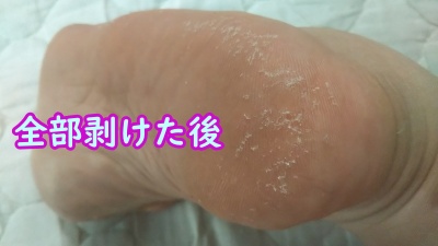 足の角質パック体験記 足の皮むけが気持ちよすぎる 今日も明日も美しく